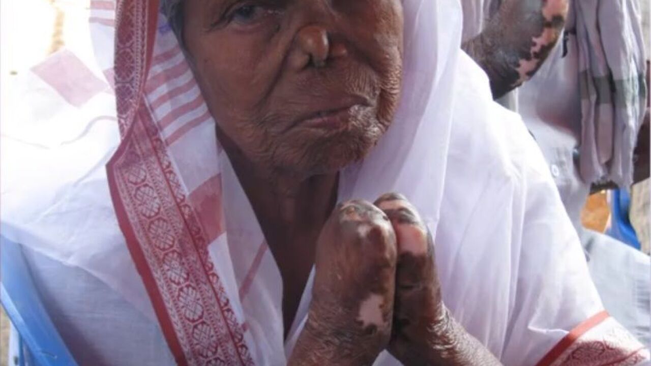 Leprosy, known as biblical scourge on the rise in Florida