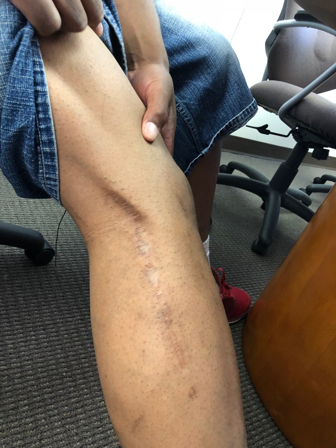 Darcel Harris’ leg.