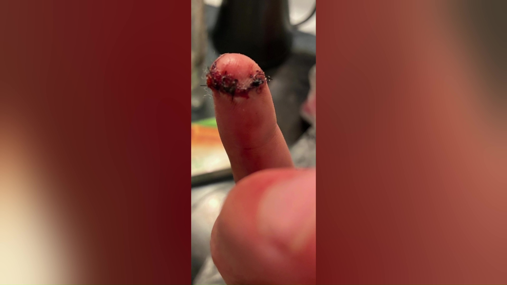 Billings man recounts being attacked by a dog