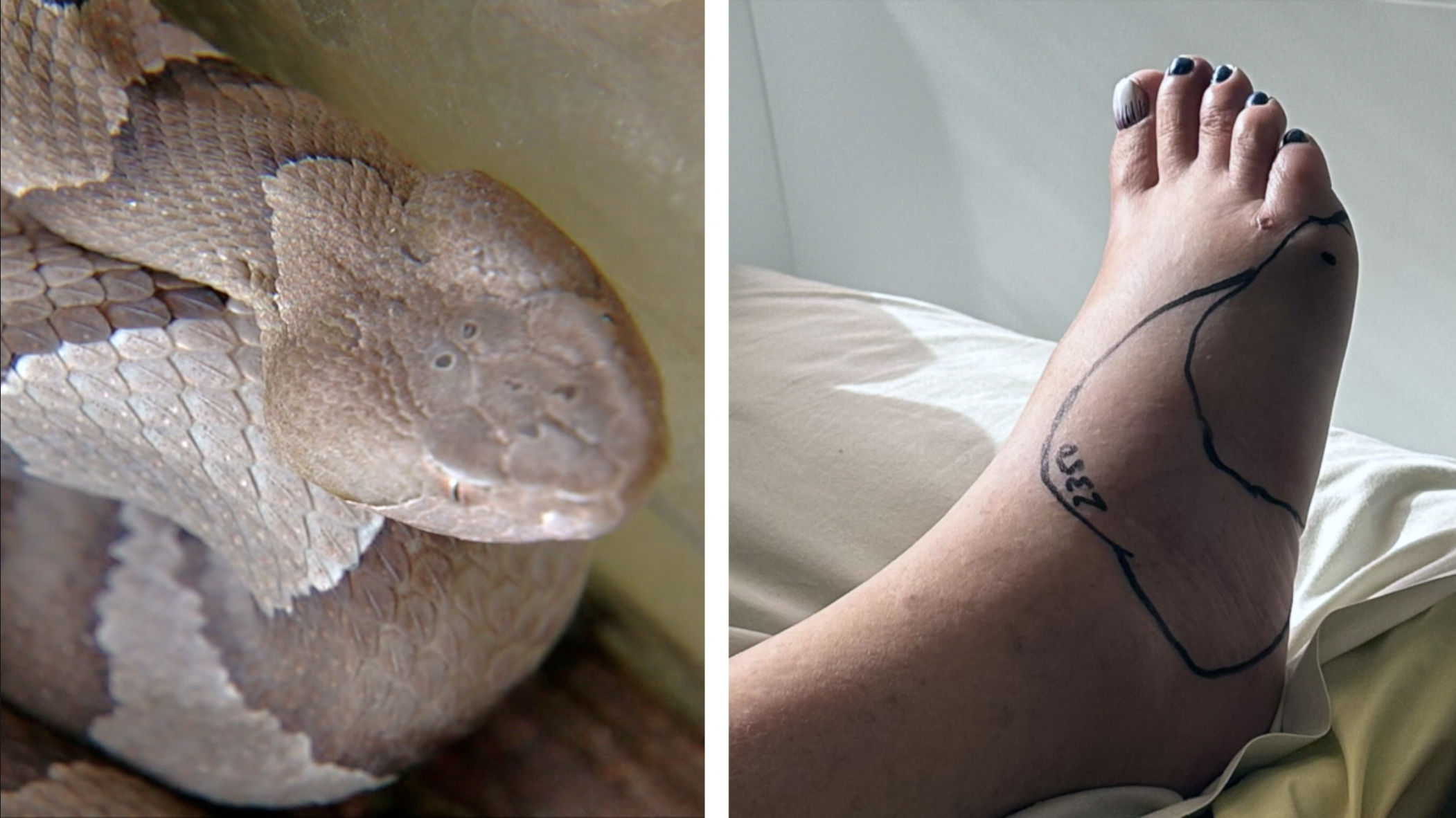 snakebite victim hillcrest pryor