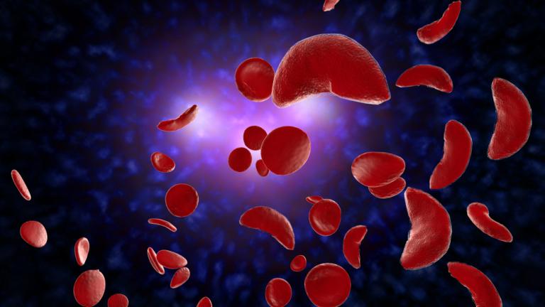 SICKLE CELL