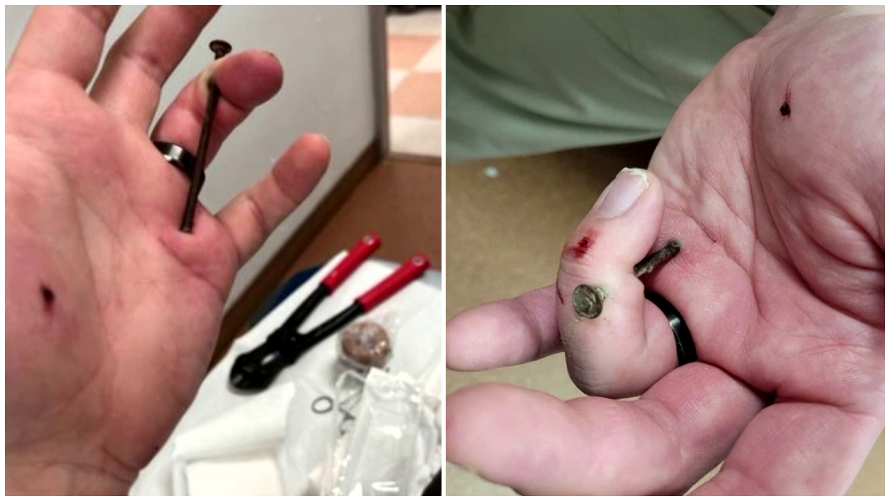 Rosebud County Sheriff's deputy recovering after nail removed from hand