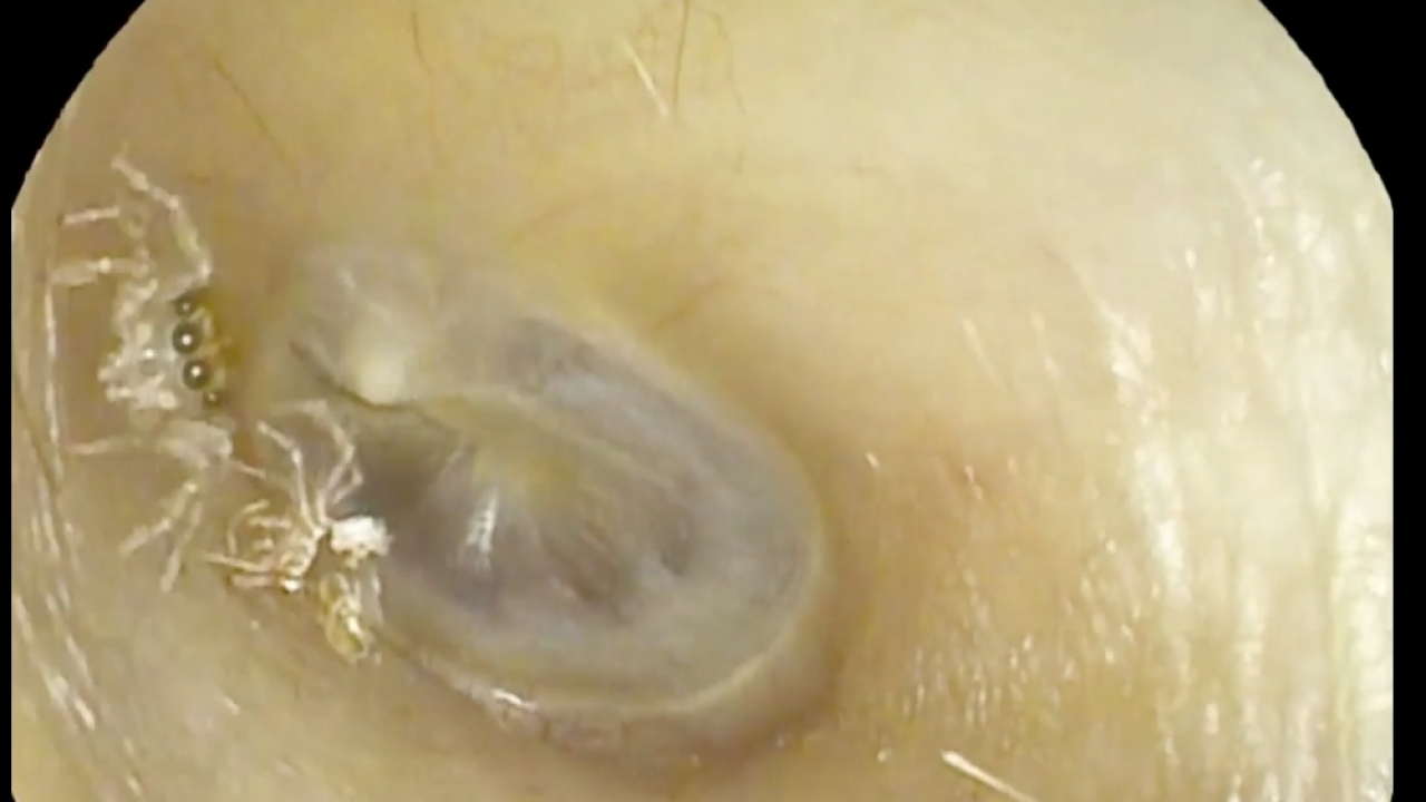 A spider and its exoskeleton inside a woman's ear canal.