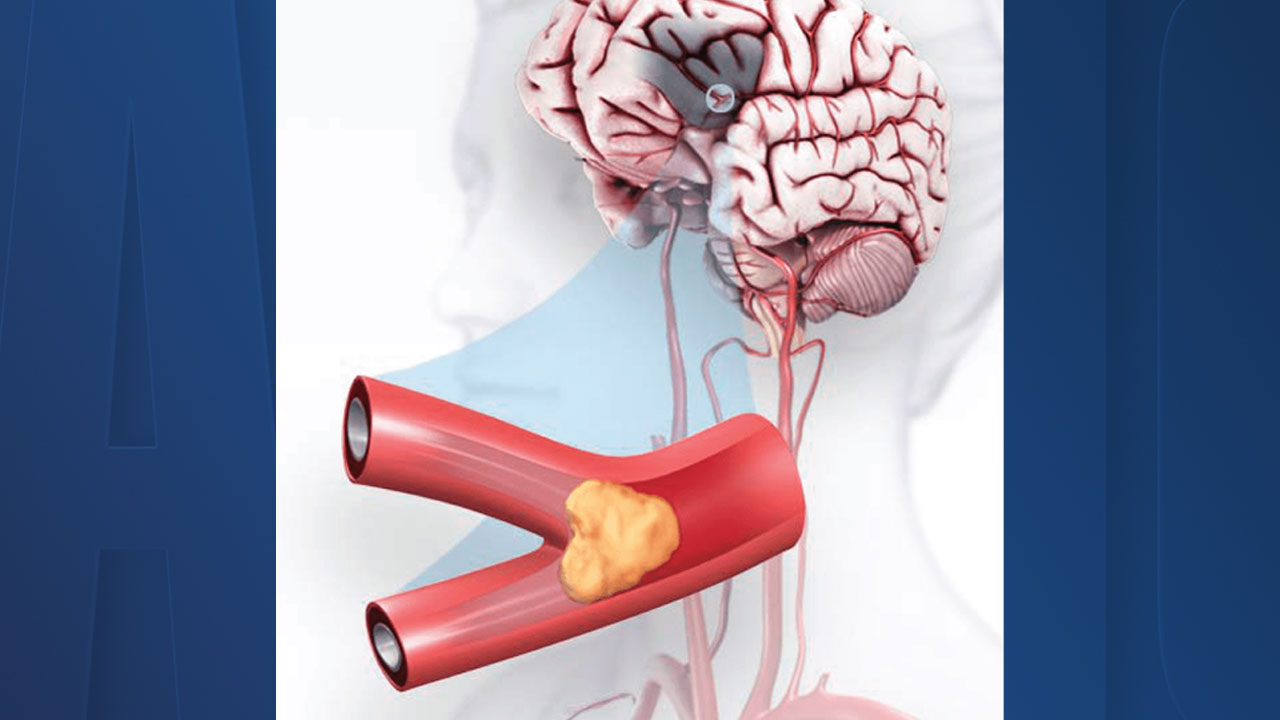 Illustration of a stroke