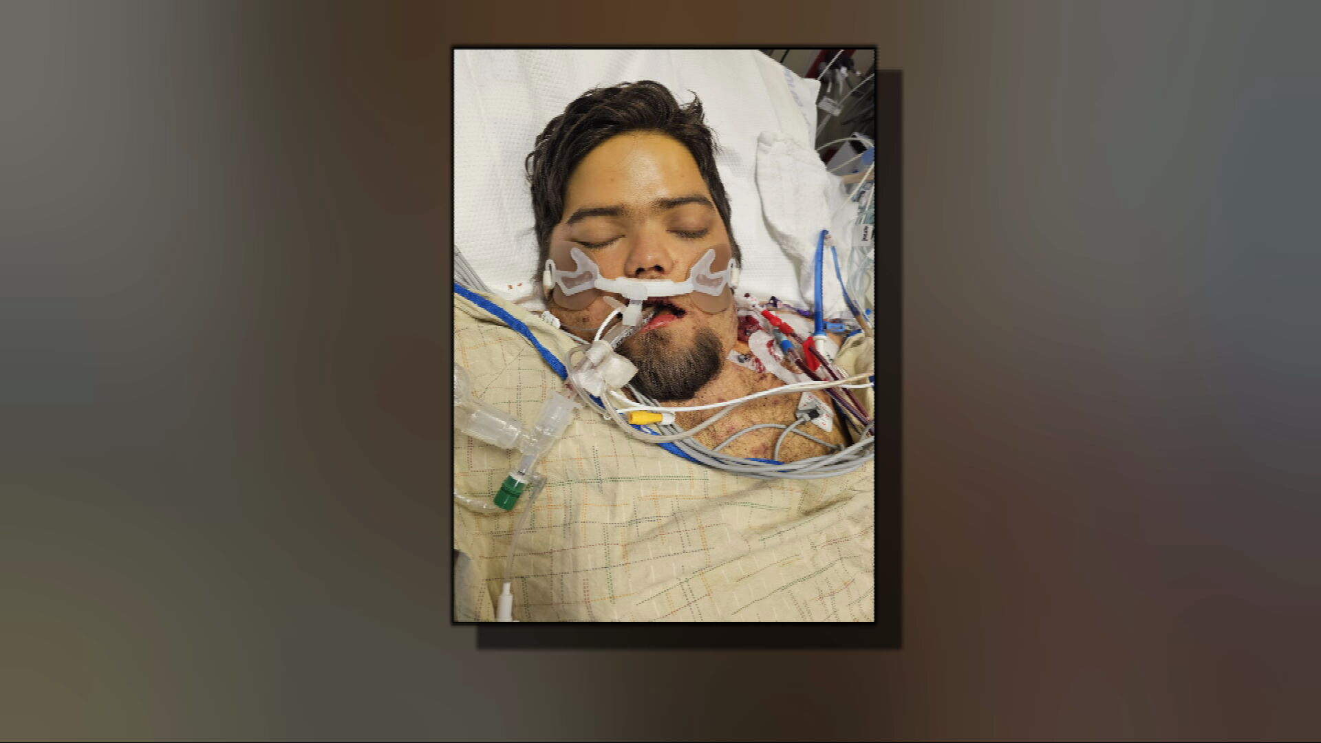 Histoplasmosis patient Liam O'Neal