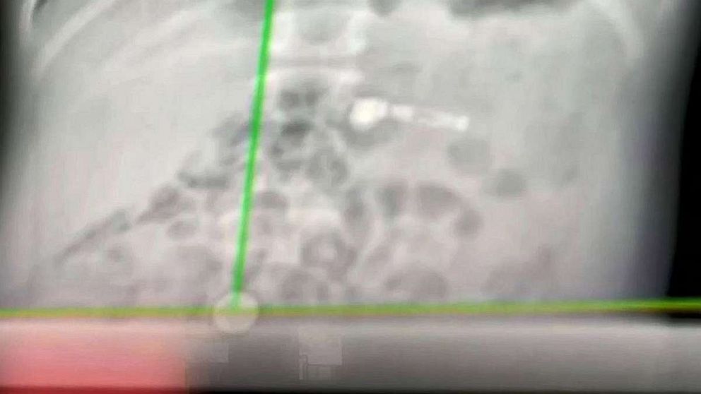 swallowed airpod.jpg