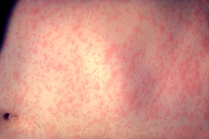 KNXV Measles